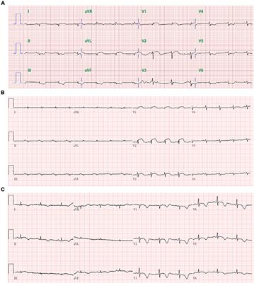 Acute Fulminant Myocarditis After ChAdOx1 nCoV-19 Vaccine: A Case Report and Literature Review